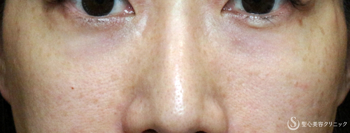 目の下の脂肪取り（経結膜下脱脂法）＋プレミアムPRP皮膚再生療法（目の下のくま）＋プレミアムPRP皮膚再生療法_After
