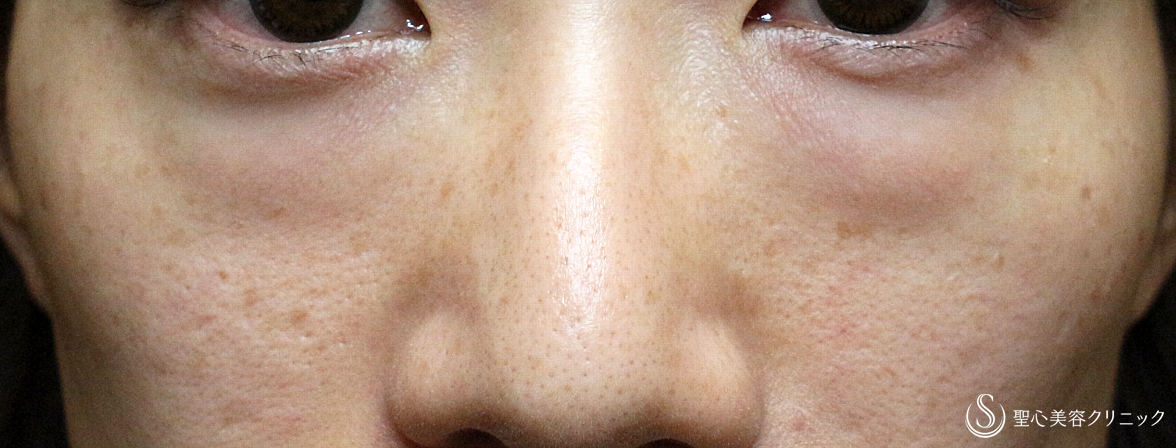 目の下の脂肪取り（経結膜下脱脂法）＋プレミアムPRP皮膚再生療法（目の下のくま）＋プレミアムPRP皮膚再生療法_Before